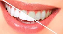 ۵ اشتباه رایجی که باعث زردی دندان ها می شود