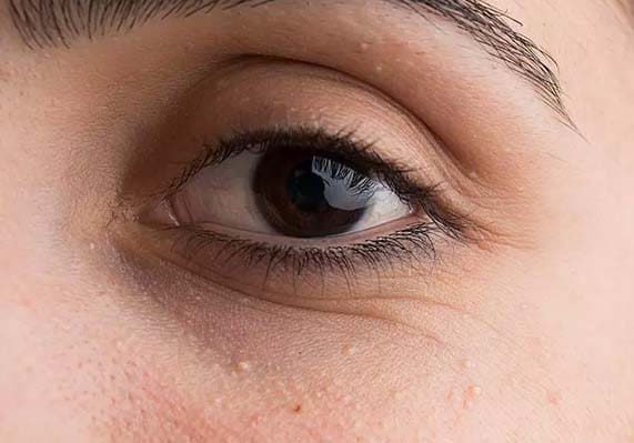 علت ایجاد میلیا زیر چشم و درمان آن