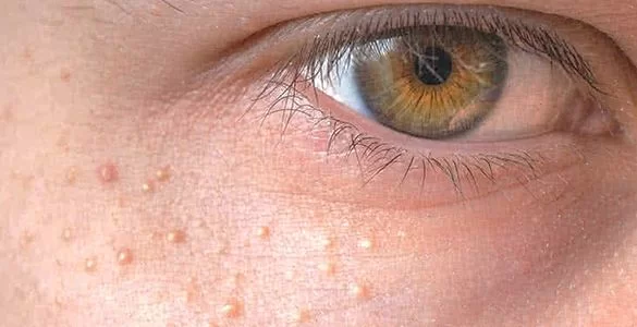 علت ایجاد میلیا زیر چشم و درمان آن