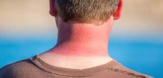 چند روش عالی برای درمان آفتاب سوختگی در تابستان