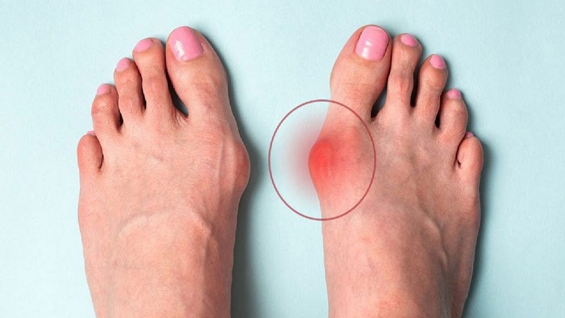 عارضه انحراف شست پا چیست و چگونه درمان می شود؟