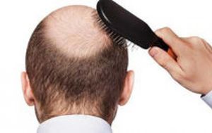 آنچه باید درباره ریزش دائمی موی سر بدانید