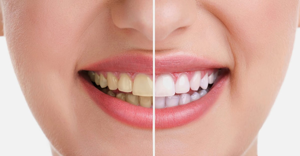 سه روش طبیعی و خانگی برای سفید کردن دندانها