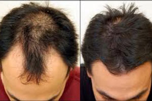 درمان جدید برای رویش مجدد موی سر با یک روغن گیاهی