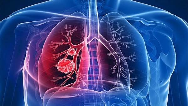 ۶ نشانه آلودگی ریه‌ها را بشناسید
